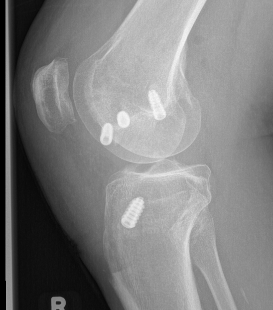 ACL + Posterolateral corner reconstruction 2